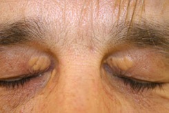 page11-xanthelasma-pictures