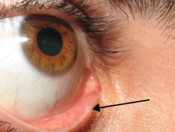 page12-797px-lacrimal_punctum