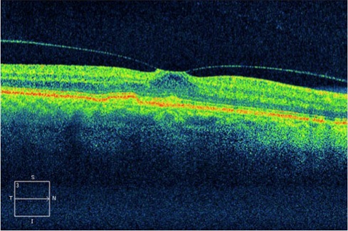 Макулярный разрыв после операции