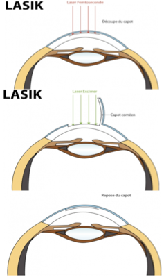 page27-lasik