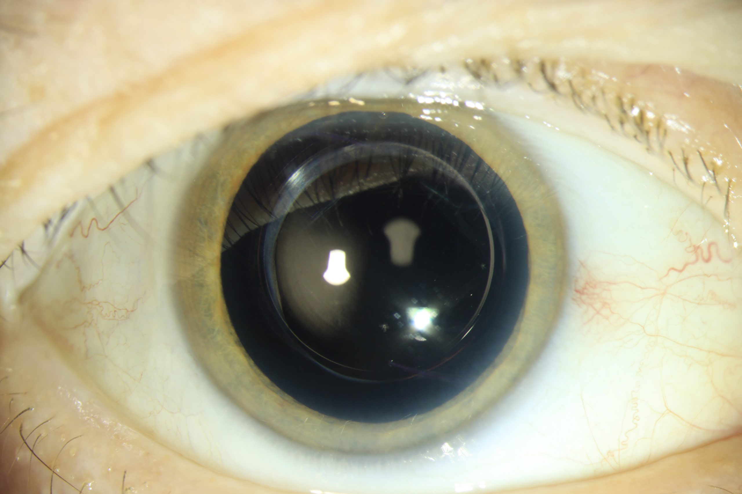 Chirurgie de la cataracte – CAPVISION